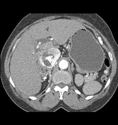 Clear Cell Renal Cell Carcinoma (RCC) With Involvement of Renal Vein and IVC Extending Into Right Atrium - CTisus CT Scan