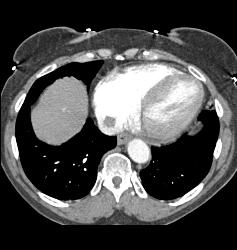 Clear Cell Renal Cell Carcinoma (RCC) With Involvement of Renal Vein and IVC Extending Into Right Atrium - CTisus CT Scan
