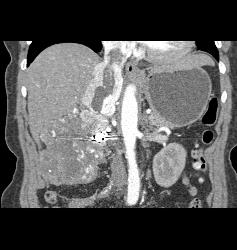 Clear Cell Renal Cell Carcinoma (RCC) With Involvement of Renal Vein and IVC Extending Into Right Atrium - CTisus CT Scan