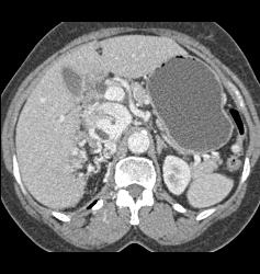 Clear Cell Renal Cell Carcinoma (RCC) With Involvement of Renal Vein and IVC Extending Into Right Atrium - CTisus CT Scan