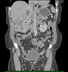 Clear Cell Renal Cell Carcinoma (RCC) With Involvement of Renal Vein and IVC Extending Into Right Atrium - CTisus CT Scan