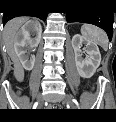 Subcapsular Hematoma - CTisus CT Scan