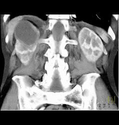 Subcapsular Hematoma - CTisus CT Scan