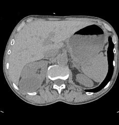 Subcapsular Hematoma - CTisus CT Scan