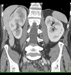 Subcapsular Hematoma - CTisus CT Scan