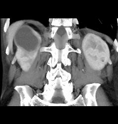 Subcapsular Hematoma - CTisus CT Scan