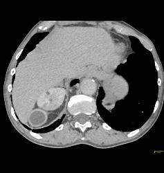 Subcapsular Hematoma - CTisus CT Scan