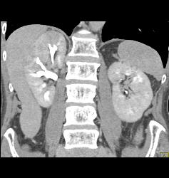 Subcapsular Hematoma - CTisus CT Scan