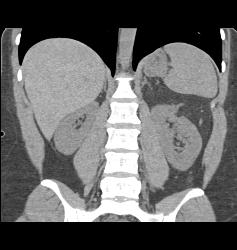 Renal Angiomyelolipoma - CTisus CT Scan