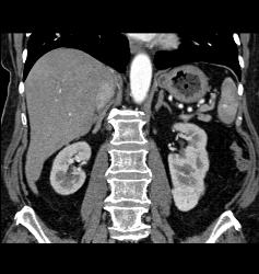 Renal Cell Carcinoma - CTisus CT Scan