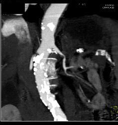 Renal Artery Stenosis - CTisus CT Scan