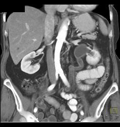 Left Hydronephrosis Due to Tumor Recurrence Near Anastomosis - CTisus CT Scan