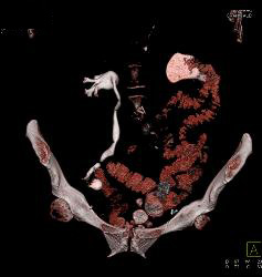 Left Hydronephrosis Due to Tumor Recurrence Near Anastomosis - CTisus CT Scan