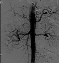Fibromuscular Dysplasia of Right Renal Artery - CTisus CT Scan