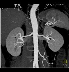 Fibromuscular Dysplasia of Right Renal Artery - CTisus CT Scan