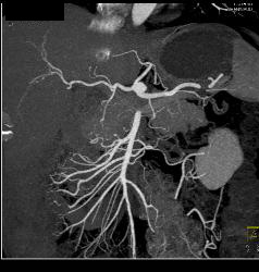 Mesenteric Arcade Ok in Patient With Renal Fibromuscular Dysplasia (FMD) - CTisus CT Scan