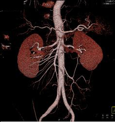 Fibromuscular Dysplasia of Right Renal Artery - CTisus CT Scan