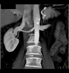 Normal Renal Vein - CTisus CT Scan