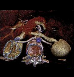 Normal Renal Vein - CTisus CT Scan