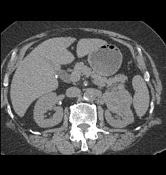 Renal Cell Carcinoma - CTisus CT Scan
