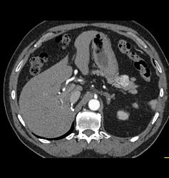 Recurrent Renal Cell Carcinoma With Metastases to the Pancreas - CTisus CT Scan