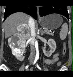 Renal Cell Carcinoma Involves the Adrenal Gland- Hypervascular - CTisus CT Scan