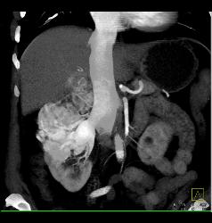 Renal Cell Carcinoma Involves the Adrenal Gland- Hypervascular - CTisus CT Scan