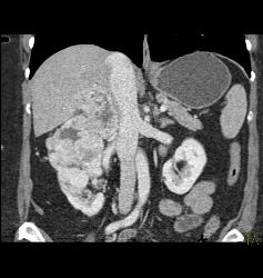 Renal Cell Carcinoma Involves the Adrenal Gland- Hypervascular - CTisus CT Scan