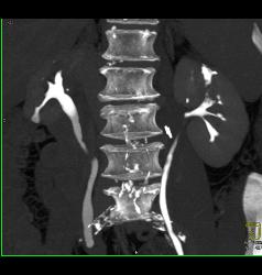 Transitional Cell Cancer (TCC) of Left Kidney- See CT Urogram and Full Sequence of Images - CTisus CT Scan