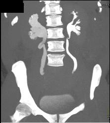 Right Hydronephrosis - CTisus CT Scan