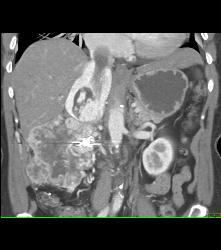 Renal Cell Carcinoma Invades the Inferior Vena Cava (IVC) and Right Atrium With Neovascularity - CTisus CT Scan