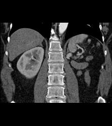 1 Cm Recurrence in Left Renal Bed - CTisus CT Scan