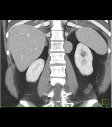 Unusual Bronchogenic Cyst Off Diaphragm Presents as A New Renal Mass - CTisus CT Scan