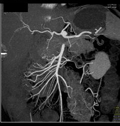 Fibromuscular Dysplasia (FMD) of Right Renal Artery the Mesenteric Vessels Were Normal - CTisus CT Scan