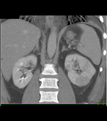 Acute Pyelonephritis- Multiple Phases - CTisus CT Scan