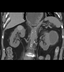 High Density Renal Cyst- Right Kidney- and Cystic Renal Cell Carcinoma in Left Kidney - CTisus CT Scan
