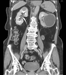 High Density Renal Cyst- Right Kidney- and Cystic Renal Cell Carcinoma in Left Kidney - CTisus CT Scan