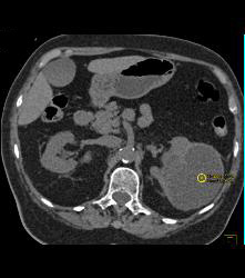 High Density Renal Cyst- Right Kidney- and Cystic Renal Cell Carcinoma in Left Kidney - CTisus CT Scan