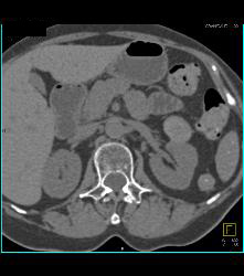High Density Left Renal Cyst - CTisus CT Scan