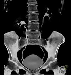 CT Urogram - CTisus CT Scan