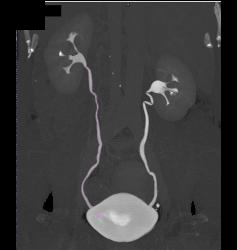 CT Urogram - CTisus CT Scan