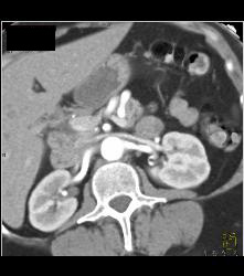 Nodal Mass Near Left Kidney- See Sequence - CTisus CT Scan
