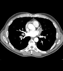 Vascular Right Renal Cell Carcinoma Invades the Renal Veins and the IVC - See Full Sequence - CTisus CT Scan