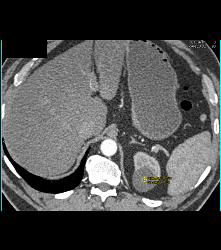 Renal Cyst - CTisus CT Scan
