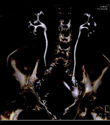 CT Urogram and Ileal Loop - CTisus CT Scan