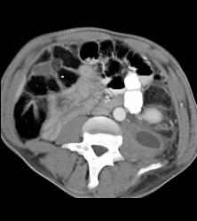 Perirenal Hematoma - CTisus CT Scan