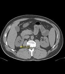 High Density 1cm Right Renal Cyst - CTisus CT Scan