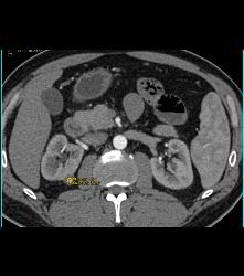 High Density 1cm Right Renal Cyst - CTisus CT Scan