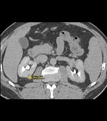 High Density 1cm Right Renal Cyst - CTisus CT Scan