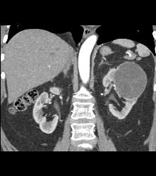 Cystic Nephroma Vs. Cystic Left Renal Cell Carcinoma- See Full Sequence of Images- the Final Diagnosis Was A Cystic Nephroma - CTisus CT Scan